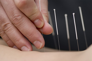 acupuncture needles