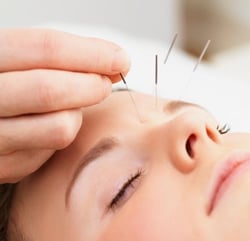 Acupuncture treatment